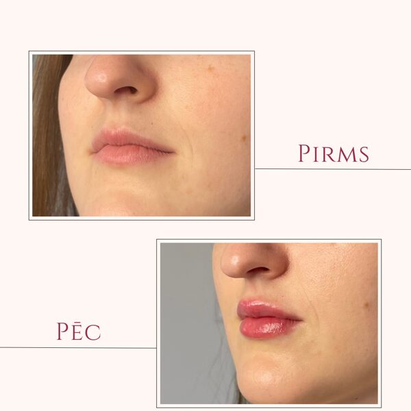 Lūpu biorevitalizācija