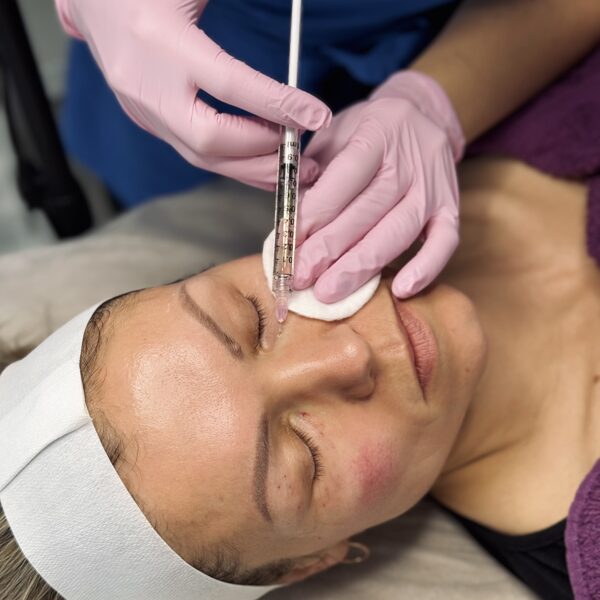 Acu zonas mezoterapija