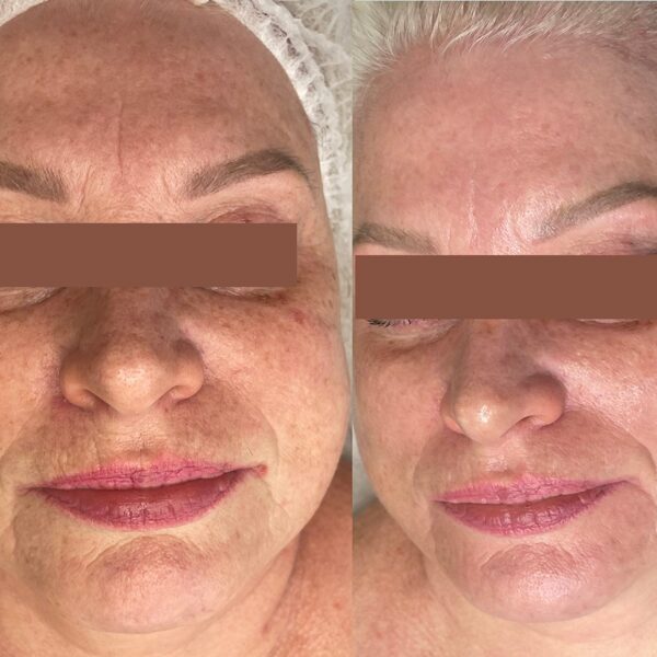 Biorevitalizācija pirms un pēc